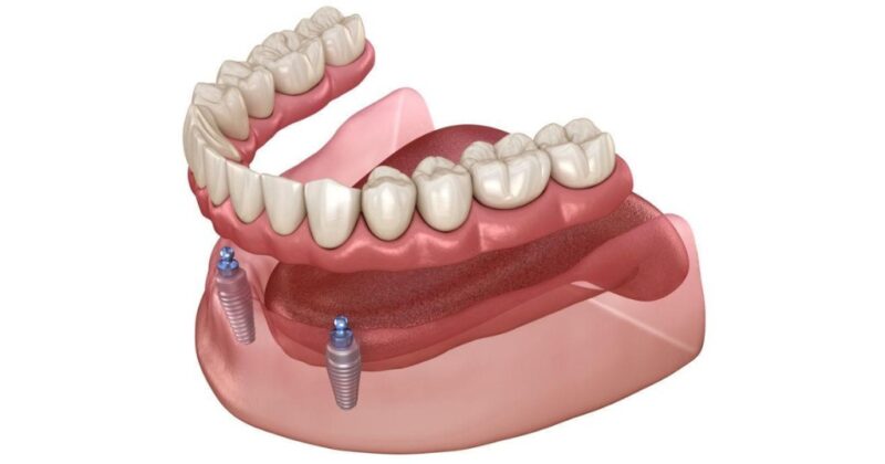 Dental Implants006