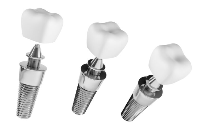 Dental Implants008