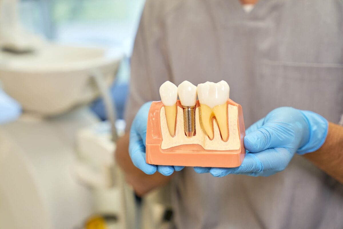 cropped-shot-of-dental-implant-model-in-hands-of-d-2023-11-27-05-15-34-utc